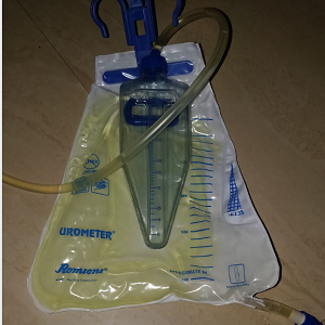 post-stroke incontinence. An image of a urine collection bag.